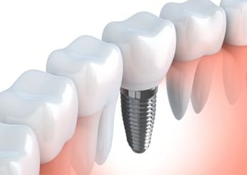 Image of a dental implant